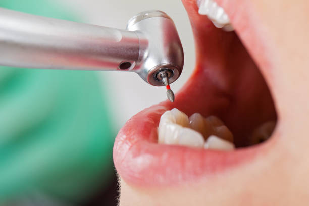 Best Emergency Wisdom Tooth Extraction in Helena, OK
